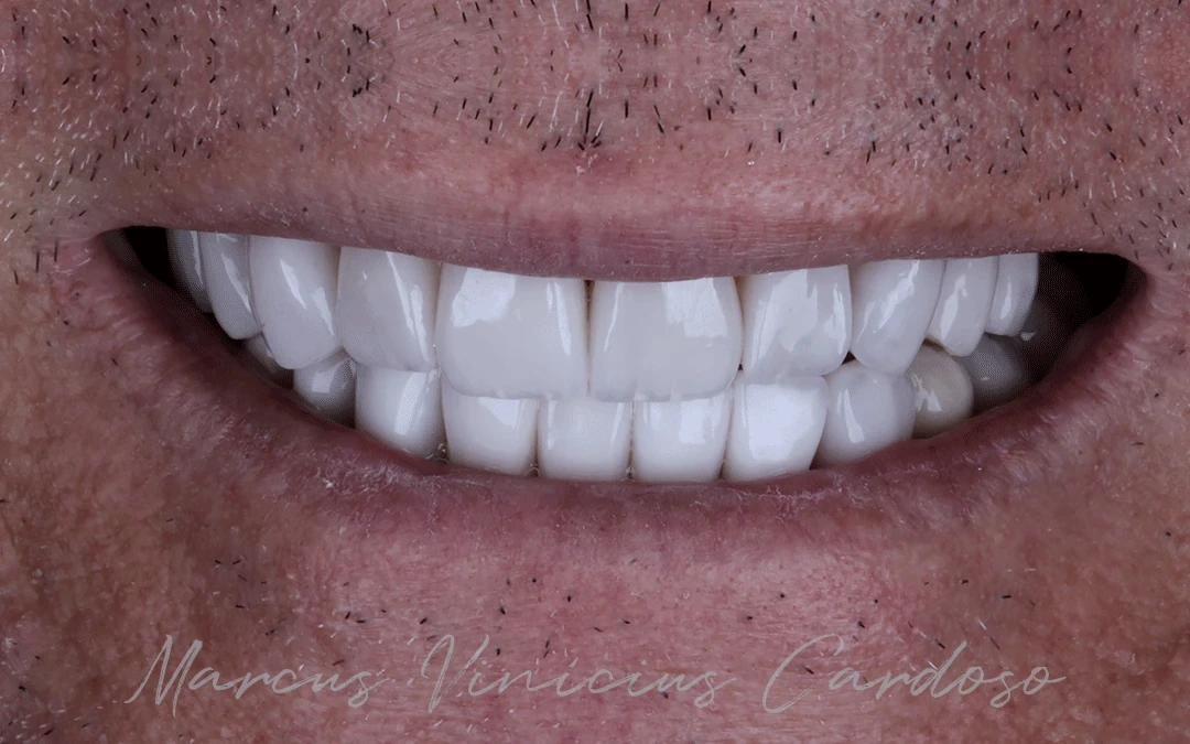 Sorriso depois do tratamento com lentes de contato dental